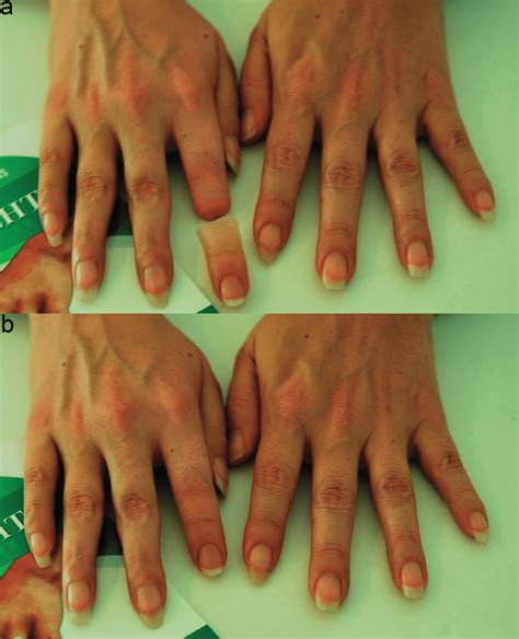 A Amputated Finger Is Shown With The Esthetic Prosthesis Before