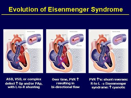 This terminology is used both for the abnormal state in humans and for normal physiological the presence of a shunt may also affect left and/or right heart pressure either beneficially or detrimentally. Eisenmenger syndrome. Causes, symptoms, treatment ...