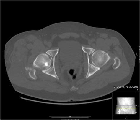 Day Six Post Operative Computed Topography Ct Scan Of Both Hip