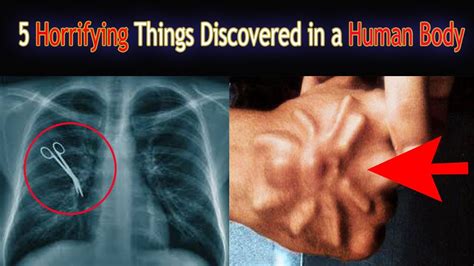 5 Most Horrifying Things Ever Discovered In A Human Body Search Party