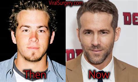 Ryan Reynolds Plastic Surgery Before And After Botox Pictures