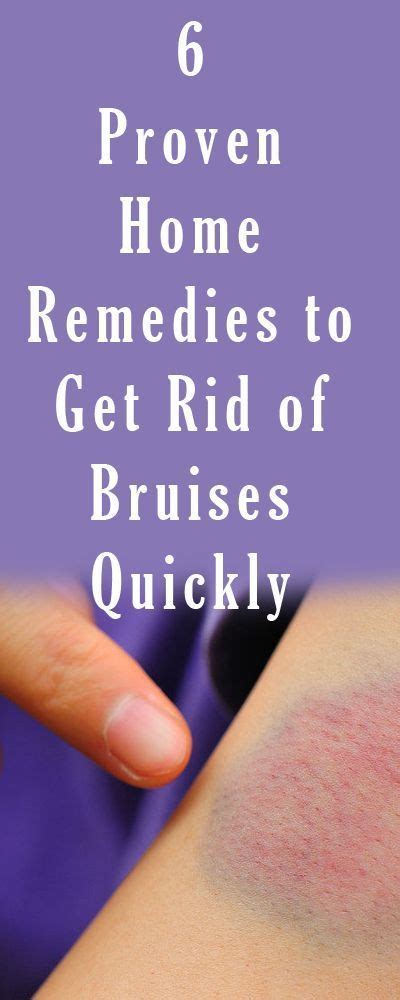 How To Get Rid Of Bruises How To Get Rid
