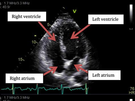 Cardiac Imaging Looking Inside The Heart Mount Sinai Medical Center