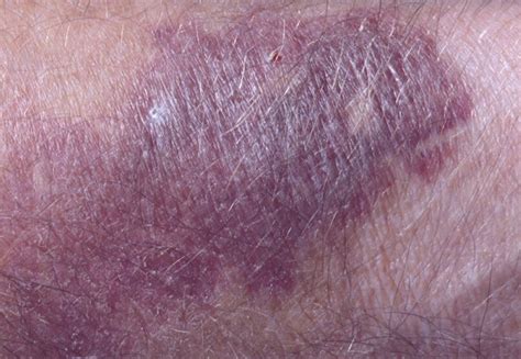 Senile Purpura Pictures Treatment Symptoms Causes