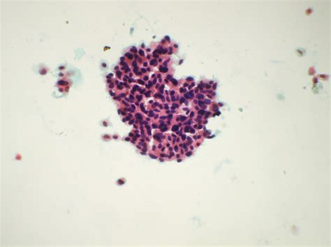 Papillary Cluster Of Malignant Atypical Cells Papanicolaous Stain ×