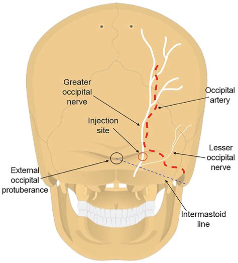Occipital Nerve Blocks In The Emergency Department For Initial