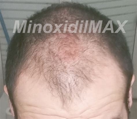 Minoxidil Results Before And After Amazing Pictures