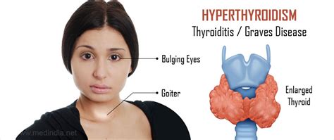 Hyperthyroidism Overactive Thyroid Causes Symptoms Diagnosis Treatment