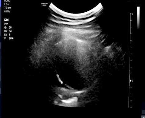 VIETNAMESE MEDIC ULTRASOUND CASE LUNG CYST Dr PHAN THANH HAI