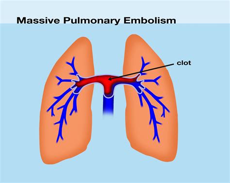 Prevention Of Pulmonary Embolism Medical Malpractice Law