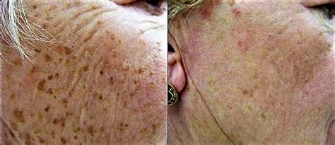 Revealing The Benefits Of Intense Pulsed Light Therapy For Freckles