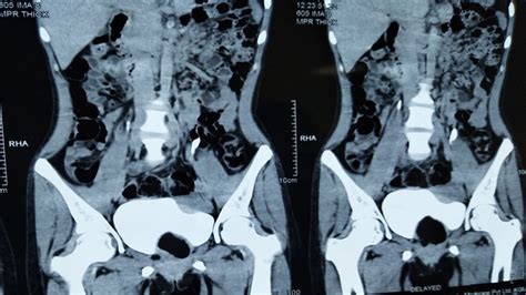 Rectal Duplication Cyst Causing Acute Urinary Retention With Bladder Outlet Obstruction An