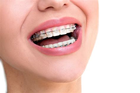 The Damon System Self Ligating Braces Ooli Orthodontics