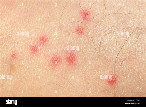 Skin Allergy Hi Res Stock Photography And Images Alamy