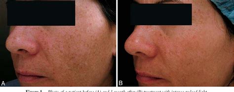 Figure 1 From Clinical Improvement Of Photodamaged Skin After A Single
