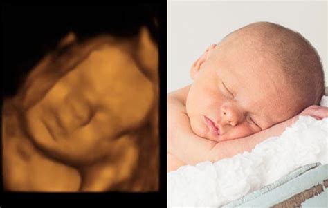 Fibroid diagnostics in brooklyn, ny. 3D ultrasound images - Sweet Baby O' Mine Ft. Myers, Florida