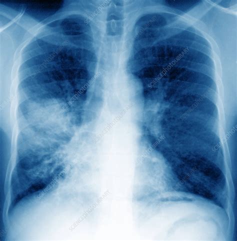 Pneumonia is an infection of the lungs. Bacterial pneumonia, X-ray - Stock Image - M240/0543 - Science Photo Library