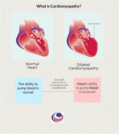 Dilated Cardiomyopathy Pictures