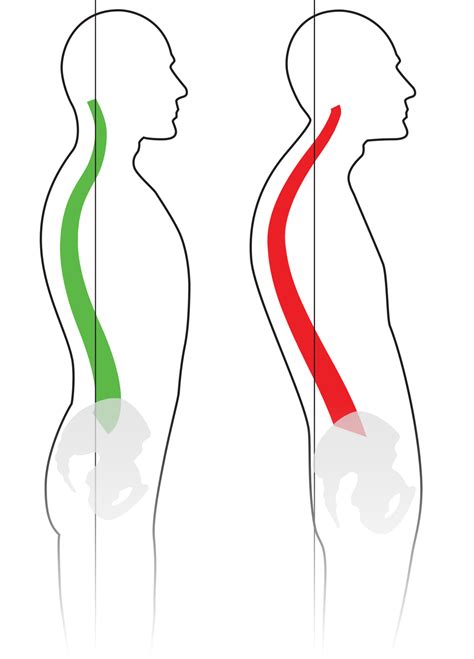 Spinal Column Kyphosis Thoracic Kyphosis Spinal Deformity