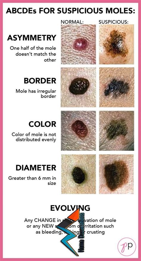 The Abcdes Of Suspicious Moles Skin Disorders Cancerous Moles How