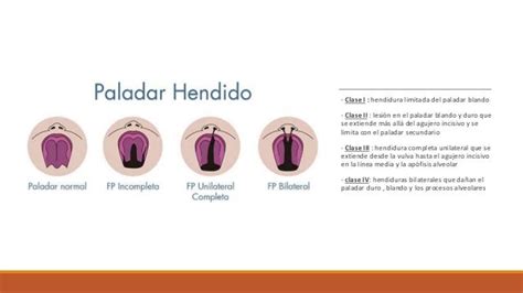 Labio Y Paladar Hendido