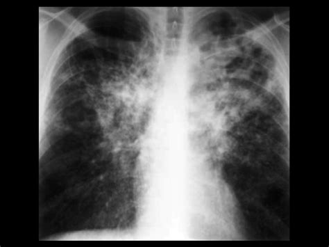 Tuberculosis, but other mycobacteria occasionally infect humans, like m. Tuberculosis - Cancer Therapy Advisor