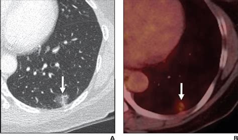 Figure 9—61 From Ground Glass Nodules On Chest Ct As Imaging Biomarkers