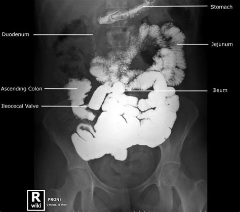Radiographic Anatomy Abdomen Ap Supine Sbs Imagenologia Radiología