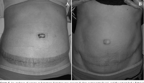 Figure 5 From Single Port Repair Of Diastasis Recti And Umbilical