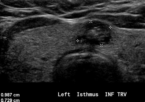 Thyroid Imaging Reporting And Data System Ti Rads A Users Guide