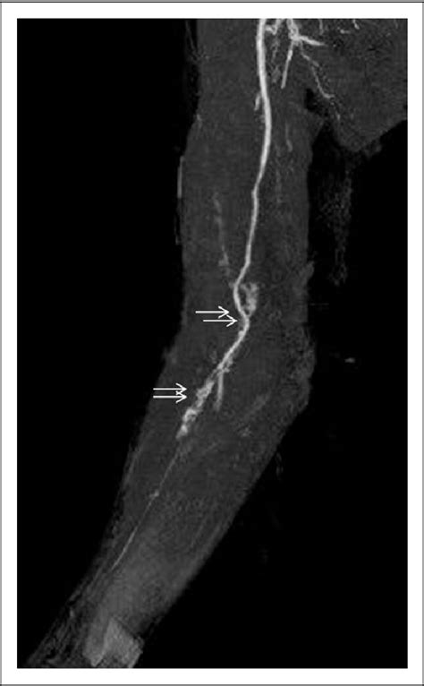 Figure From Acute Compartment Syndrome Of The Forearm Associated With