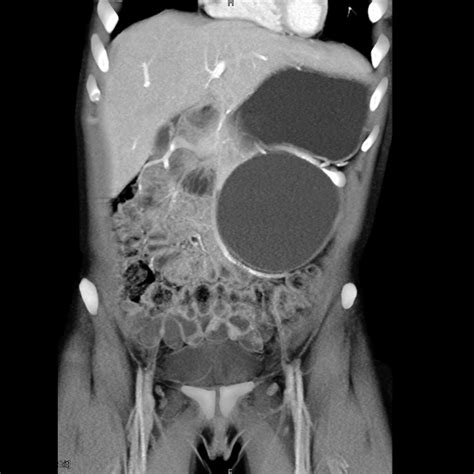 Pancreatic Cyst Clinic Gathers World Class Experts Johns Hopkins Medicine