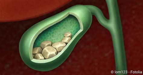 Des weiteren sind gallenstein symptome eher unspezifisch und schwer zu trennen von anderen krankheitsbildern. Gallensteine (Cholelithiasis): Ursachen, Behandlung ...