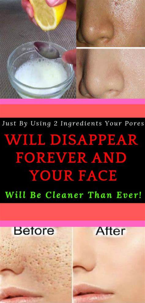 Just By Using 2 Ingredients Your Pores Will Disappear Forever And Your