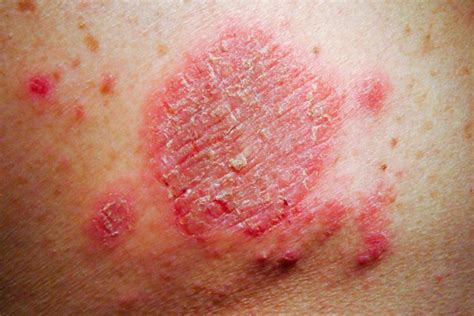 O Que é Eczema Quais São As Causas Os Sintomas E Mais