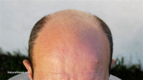Pattern hair loss is hair loss that primarily affects the top and front of the scalp. Male pattern baldness linked to prostate cancer through ...