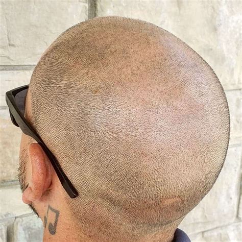 Where To Get Scalp Micropigmentation In Toronto Chronic Ink