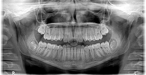 What Do Dentists Look For In X Rays Merion Village Dental