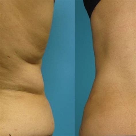 Back Liposuction Average Cost Of Liposuction In Cincinnati Vaser Lipo