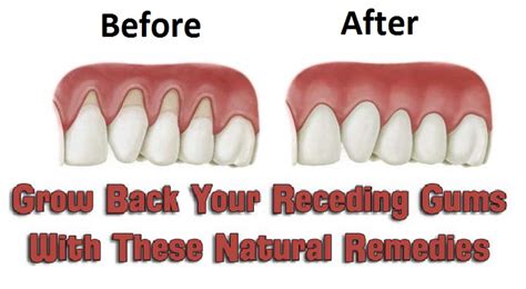 Grow Back Your Receding Gums With These Natural Remedies — Look Feel