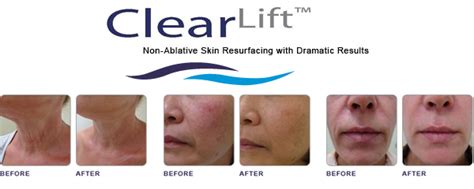 Clearlift Anti Ageing Treatment In London Hc Medspa
