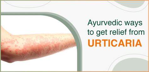 Ayurvedic Treatment For Urticaria Or Sheetapitta Problem