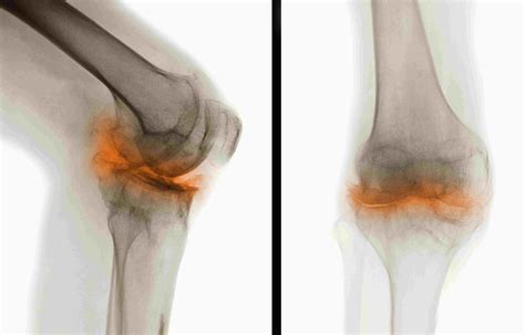 Pictures Of Osteoarthritis Locations Symptoms Diagnosis