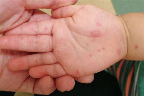 Tips To Prevent Hand Foot And Mouth Disease From Hmc Marhaba Qatar