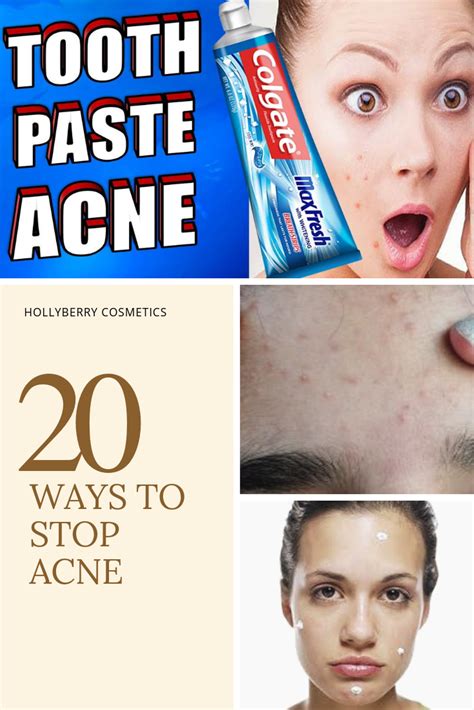 20 Ways To Stop Acne Hollyberry Cosmetics Natural Oils For Skin