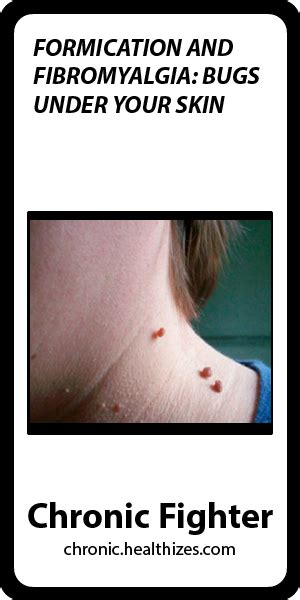 Formication And Fibromyalgia Bugs Under Your Skin Fibromyalgia