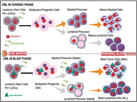 Cureus The Progression Of Chronic Myeloid Leukemia To Myeloid Sarcoma
