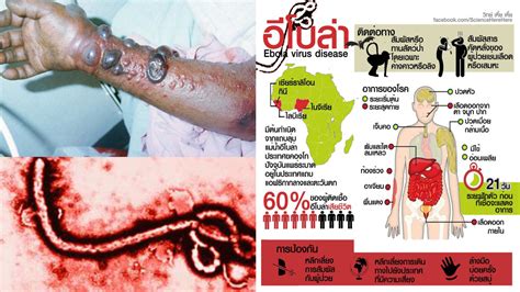 A case of laboratory infection with marburg fever. โรคอีโบลา ใหม่ Ebola virus และ Marburg virus โรคใหม่ที่คน ...