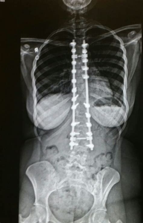 X Ray Of My Spinal Fusion Surgery June 10th 2015 Spinal Fusion