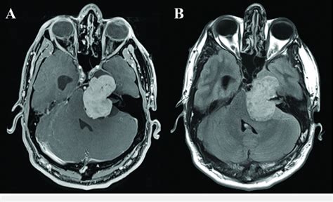 Preoperative Mri A Axial T1 Weighted Magnetic Resonance Imaging Mri